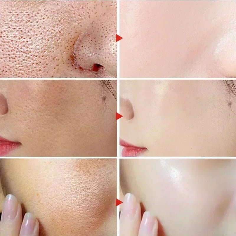 Salicylic Fruit Acid Pore Refining Face Serum for Blackheads and Oil Control - Velvet Haven